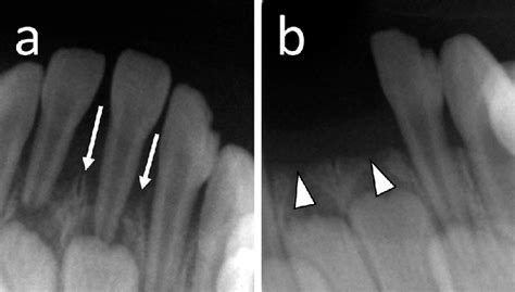 Dental X-ray showed alveolar bone absorption in the regions of the ...