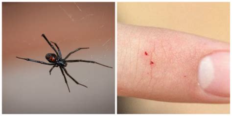 How to Identify a Spider Bite and Treat It | TruePrepper