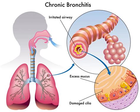 What is Bacterial Bronchitis? (with pictures)