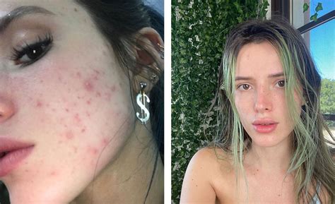 Bella Thorne Acne Transformation: Actress Shows Off Clear Skin | J-14