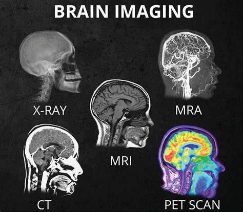 MRA Archives - San Diego Brain Injury Foundation