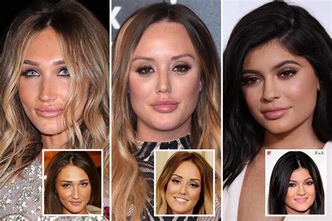 'Botched' lip fillers warning as expert says celebrities fuel rise in ...