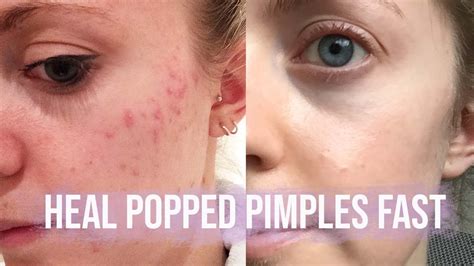 How To Reduce The Redness Of A Popped Pimple - Longfamily26