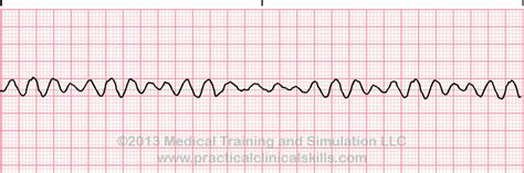 Fibrillation ventriculaire | EKG.Academy