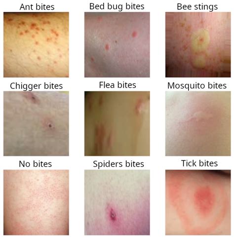 Identifying Bug Bites How To Prevent Treat Identifying Bug Bites ...