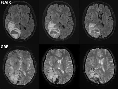 Ischemic Stroke Mri