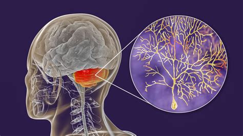 Ataxia - Acute Cerebellar : Overview, Causes, Symptoms, Treatment ...