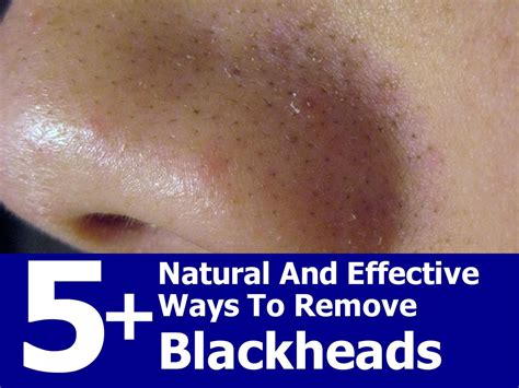 5+ Natural And Effective Ways To Remove Blackheads