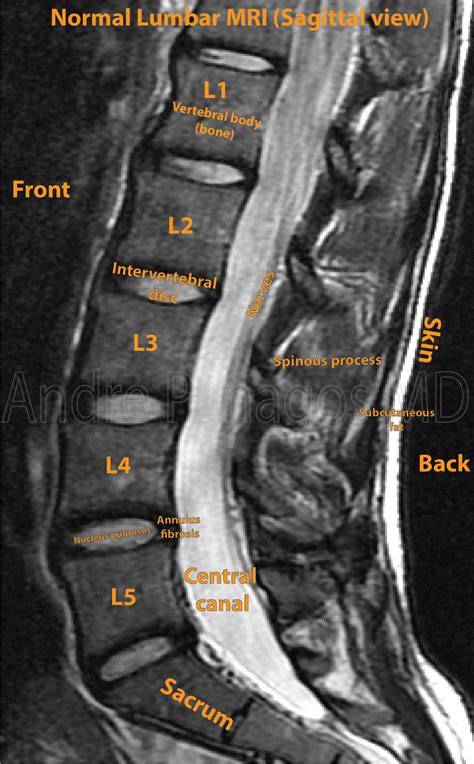 Mri Lumbar Spine Labeled