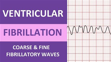 Ventricular Fibrillation (V-Fib) ECG Interpretation Nursing Heart ...