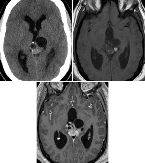 Teratoma | The Neurosurgical Atlas, by Aaron Cohen-Gadol, M.D.