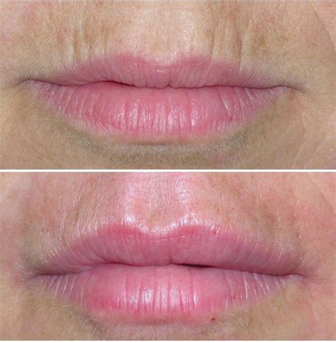 HOW TO GET RID OF WRINKLES ABOVE YOUR LIPS ? | The London Facial Care