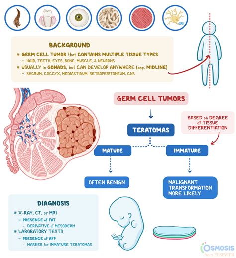 Teratoma: What Is It, Signs, Symptoms, and More | Osmosis