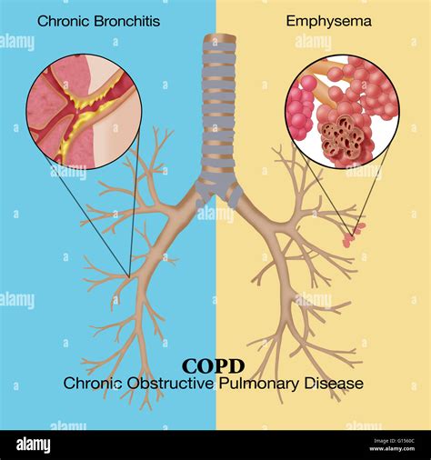 Illustration of chronic obstructive pulmonary disease (COPD), a common ...