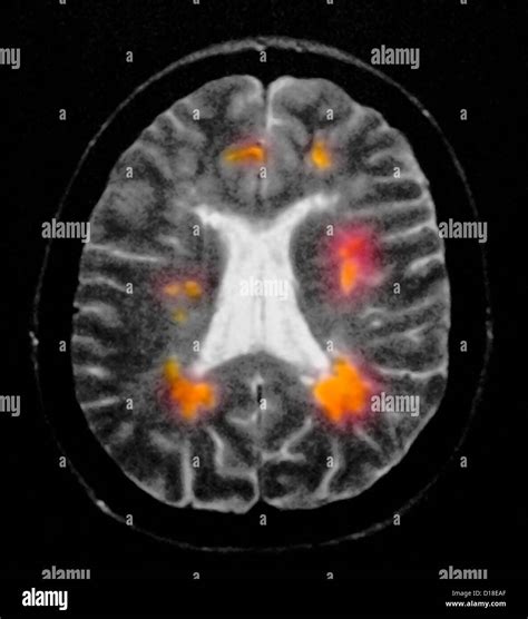 Brain MRI showing multiple sclerosis Stock Photo - Alamy