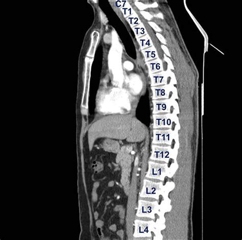 Head and spine anatomy - Radiology Cafe