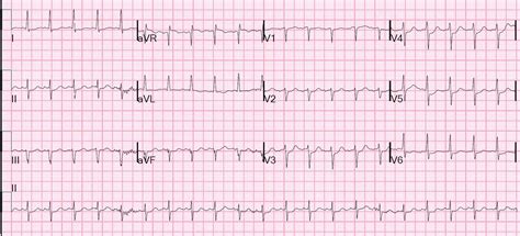 Dr. Smith's ECG Blog: Ventricular fibrillation on a 12-lead ECG