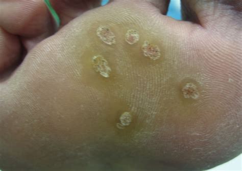 Are Foot Warts Contagious submited images.