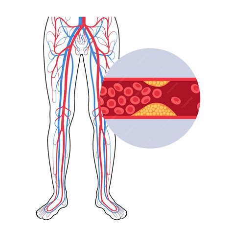 Premium Vector | Peripheral artery disease