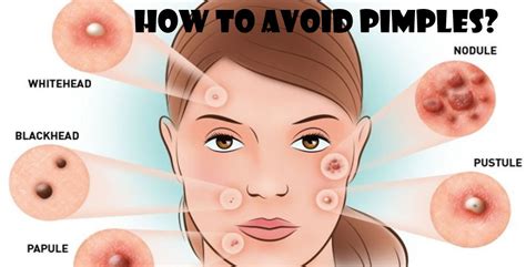 How To Avoid Pimples | Causes, Symptoms, & Rid of Acne - Whoopzz.com