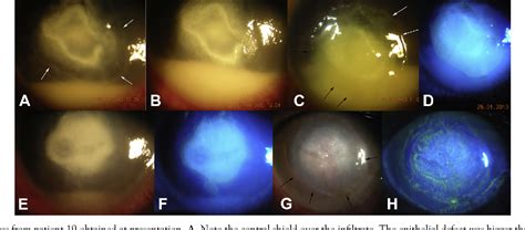 Corneal Perforation | Semantic Scholar