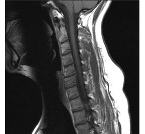 File:Cervical Spine MRI showing disc herniation.jpg - Wikimedia Commons