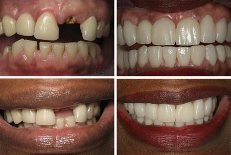 Dental Implant Before and After Photos