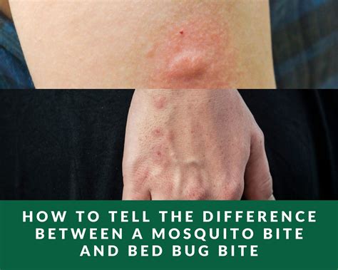 Difference Between Mosquito Bites And Bed Bug Bites – NBKomputer