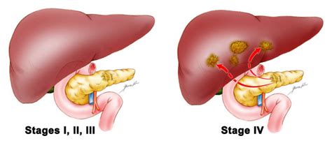 Symptoms Of Stage 4 Pancreatic Cancer