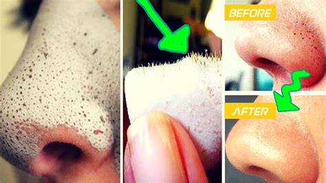 Tips to Remove Blackheads from Nose in 10 Minutes - Medy Life