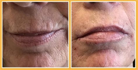 Upper Lip Wrinkles: Causes and Treatments - Bonnie Bliss