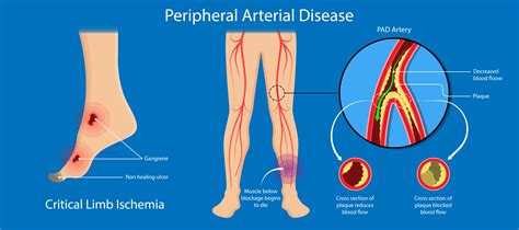 Peripheral Artery Disease – Wockhardthospitals