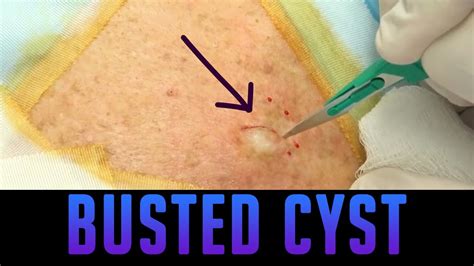 Inclusion Cyst Treatment