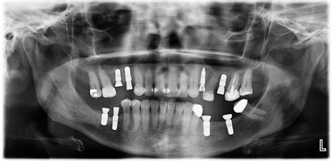 Dental X-rays and imaging done for Dental Implant Procedure?