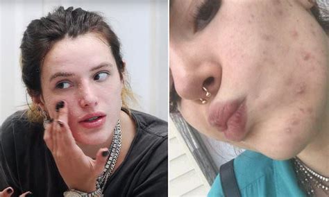 Yikes bella thorne s homemade acne scar treatment is slammed online ...