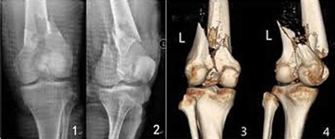 Broken femur types, causes, treatment, recovery time & complications