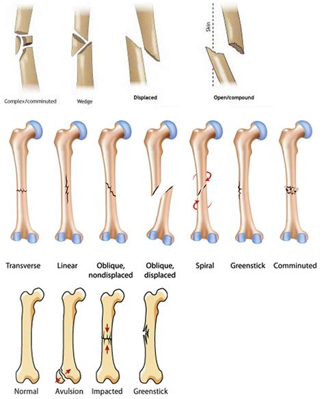 Broken femur types, causes, treatment, recovery time & complications