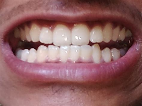 Normal teeth or bite problem? | Dentistry Forums