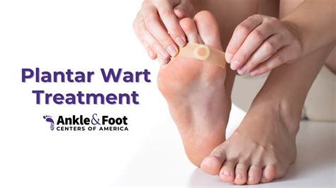 Plantar Wart Duct Tape Before After