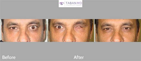 Prosthetic Eye & Socket Surgery Before and After Photos | Taban MD