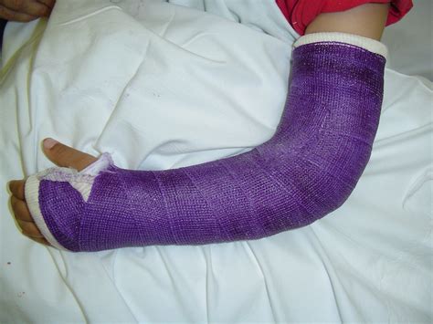 Long arm cast