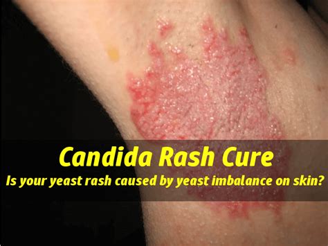 Candida rashes: is your yeast rash caused by yeast imbalance on skin?