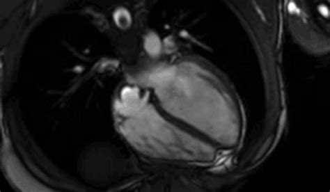 Cardiac MRI - MHVI