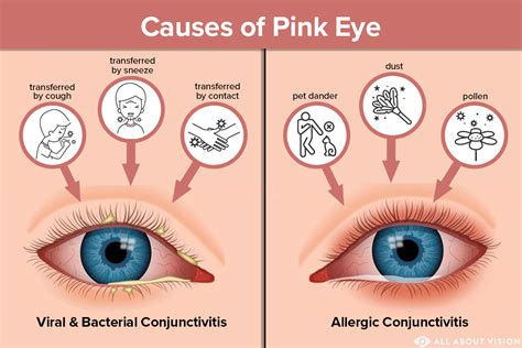 Pink Eye (Conjunctivitis) Causes - All About Vision