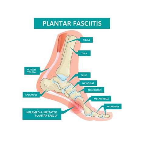 What is Plantar Fasciitis? Know Causes and Symptoms