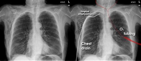 Emphysema Chest X Ray