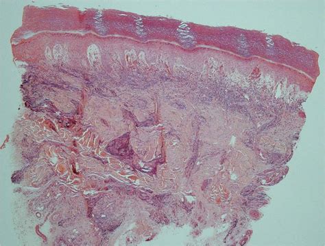 Lupus Pernio Histology