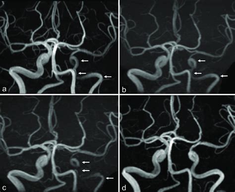 Magnetic resonance angiography (MRA) images of the patient. MRA ...