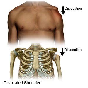 Shoulder Dislocation