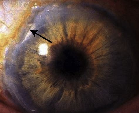 Corneal perforation resulting from marked inferior corneal thinning ...